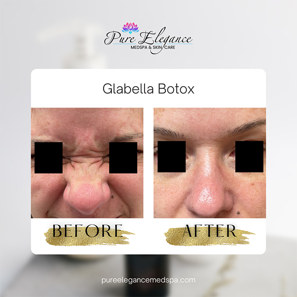 Pure Elegance MedSpa   Skin Care | Microneedling, Diamond Glow Facial and Facial Fillers