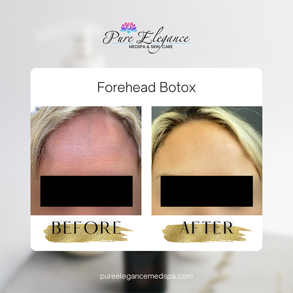 Pure Elegance MedSpa   Skin Care | Diamond Glow Facial, BOTOX reg  and Chemical Peels