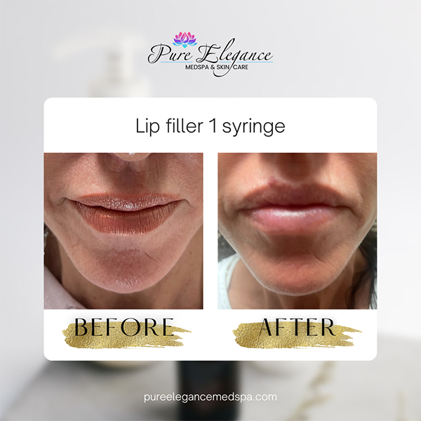 Pure Elegance MedSpa   Skin Care | Lipo B Injection, Dermaplaning and Chemical Peels
