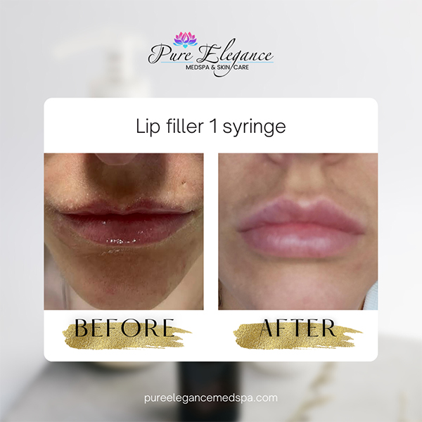 Pure Elegance MedSpa   Skin Care | BOTOX reg , B12 Injections and Lipo B Injection