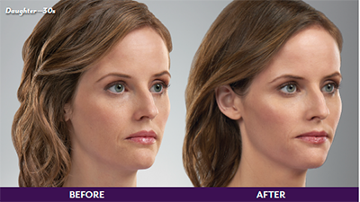 Pure Elegance MedSpa   Skin Care | Microneedling, BOTOX reg  and Dermal Fillers