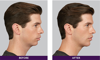 Pure Elegance MedSpa   Skin Care | DiamondGlow reg  Dermal Infusion Hydro Facial, Juvederm reg  and Back Facial