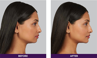 Pure Elegance MedSpa   Skin Care | Restylane reg , DiamondGlow reg  Dermal Infusion Hydro Facial and Waxing