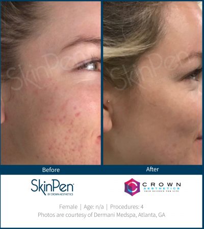 Pure Elegance MedSpa   Skin Care | Dermal Fillers, Microneedling and BOTOX reg