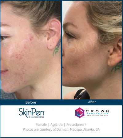 Pure Elegance MedSpa   Skin Care | BOTOX reg , Microneedling and Dermal Fillers
