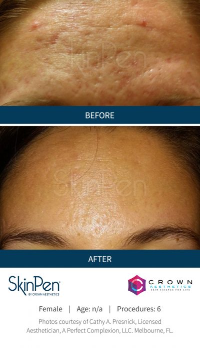 Pure Elegance MedSpa   Skin Care | Facials, Juvederm reg  and BOTOX reg