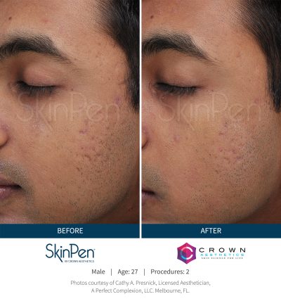 Pure Elegance MedSpa   Skin Care | Microneedling, Waxing and Dermaplaning
