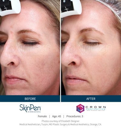 Pure Elegance MedSpa   Skin Care | Facials, Restylane reg  and Chemical Peels